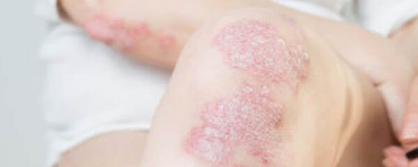 psoriasis des pieds