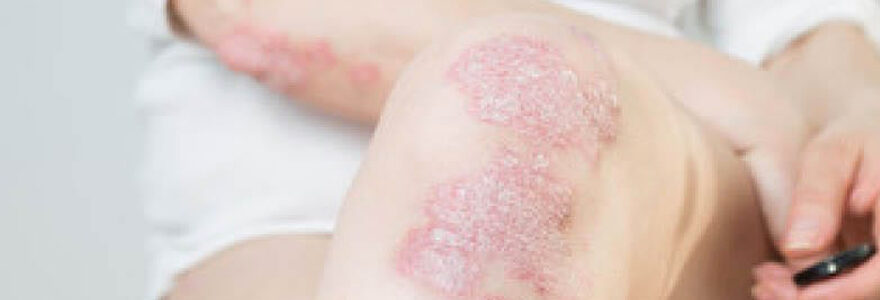 psoriasis des pieds